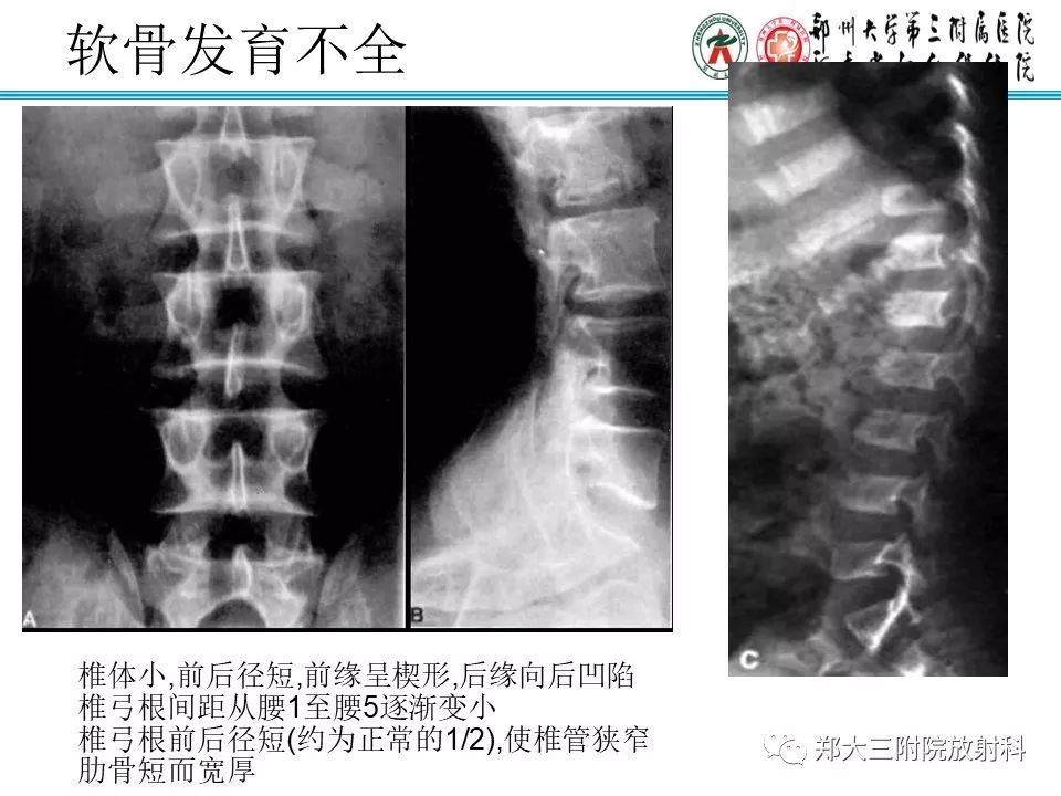 【PPT】儿童先天性骨软骨发育障碍性疾病影像诊断