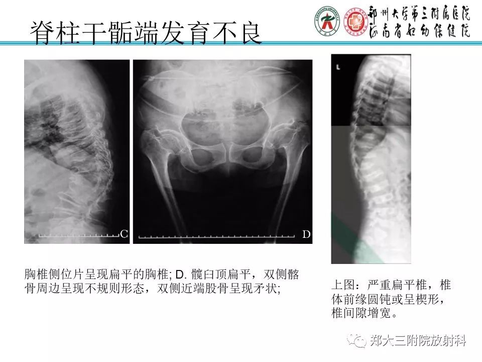 【PPT】儿童先天性骨软骨发育障碍性疾病影像诊断