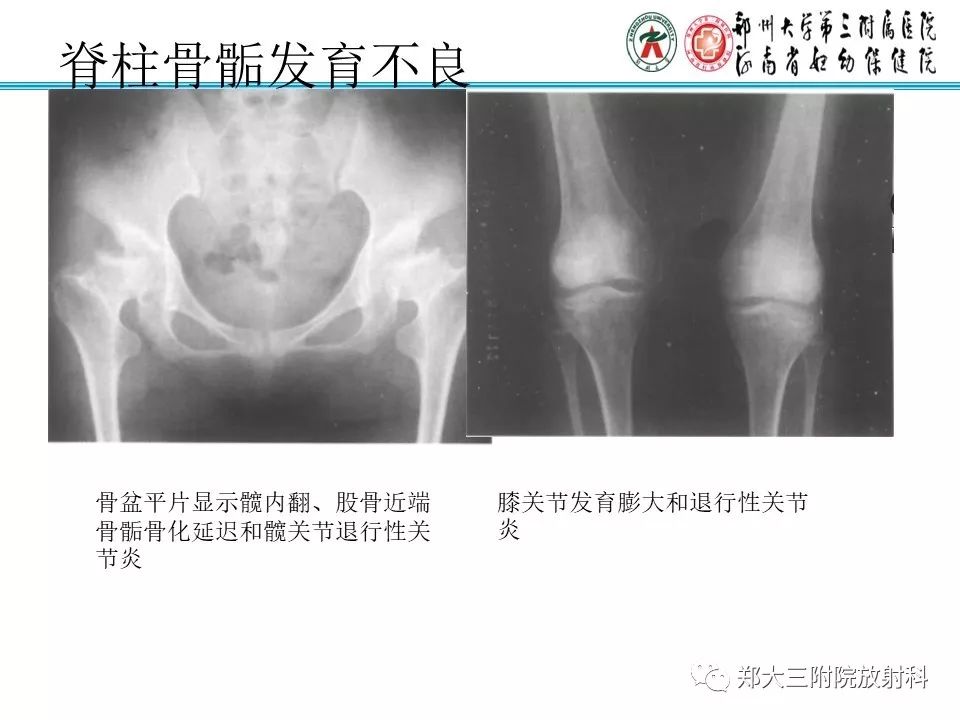 【PPT】儿童先天性骨软骨发育障碍性疾病影像诊断
