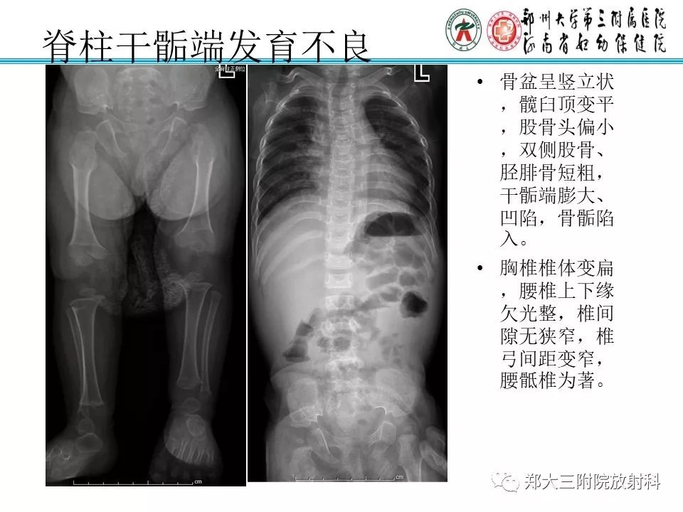 【PPT】儿童先天性骨软骨发育障碍性疾病影像诊断