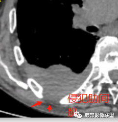 【病例】三明治征”之谜—胸膜淋巴瘤1例CT影像