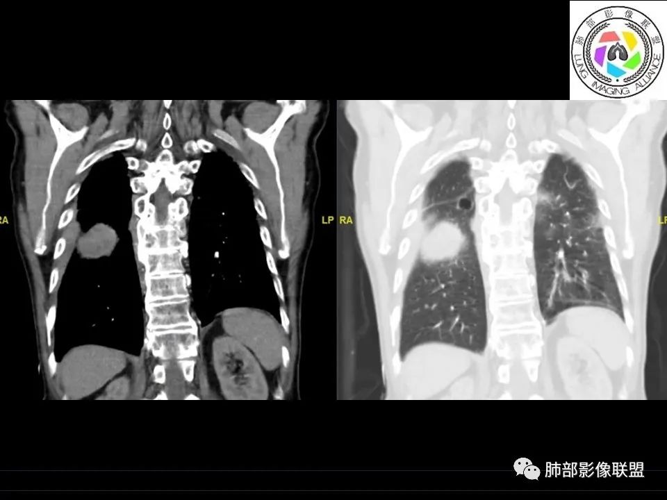 【病例】三明治征”之谜—胸膜淋巴瘤1例CT影像