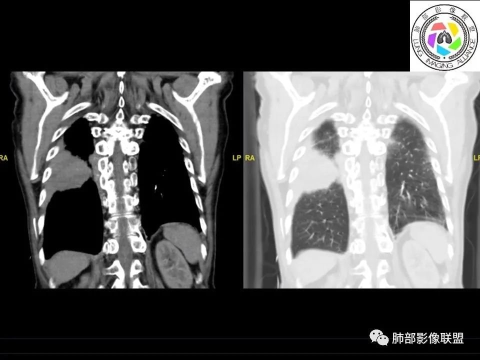 【病例】三明治征”之谜—胸膜淋巴瘤1例CT影像