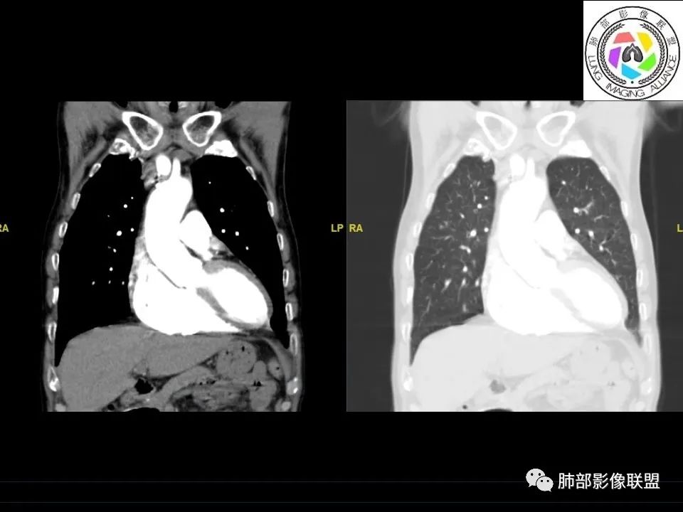 【病例】三明治征”之谜—胸膜淋巴瘤1例CT影像