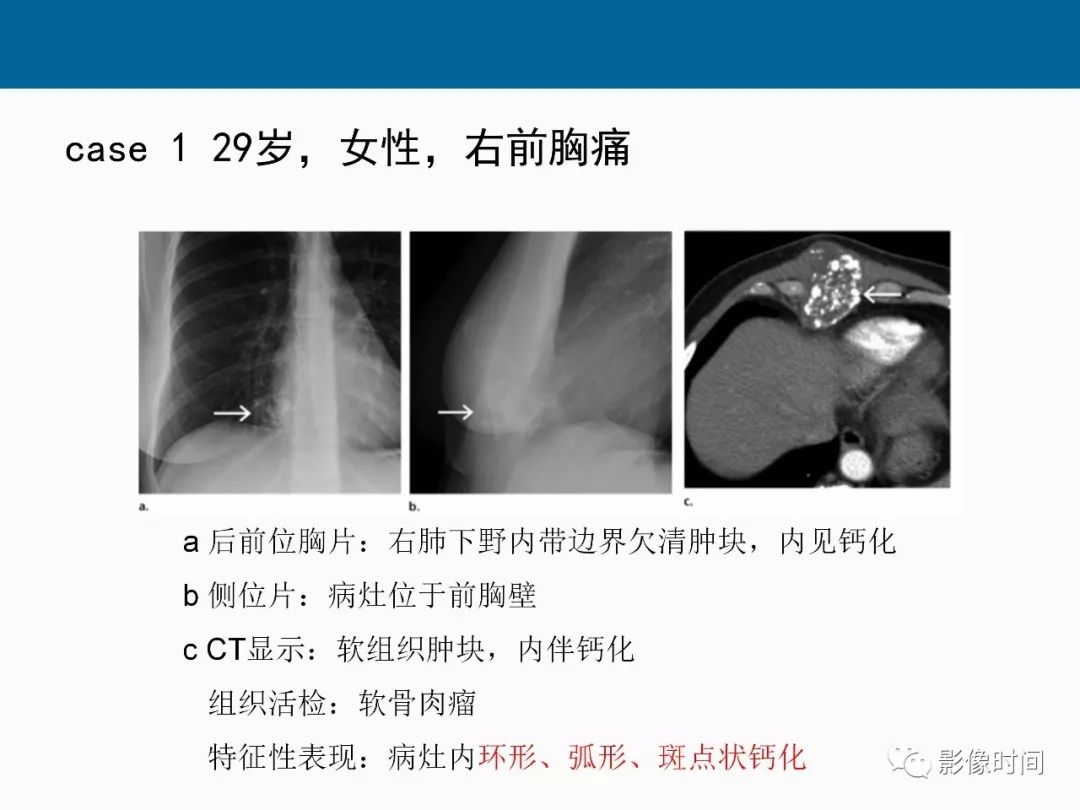 【PPT】胸壁恶性肿瘤的影像学评估