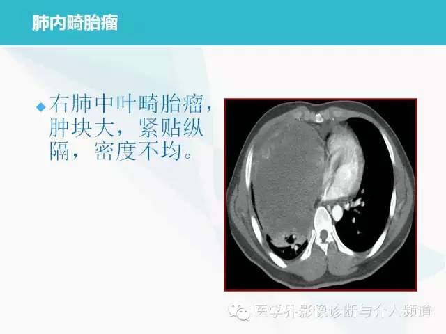 【PPT】肺良性肿瘤的影像学浅析