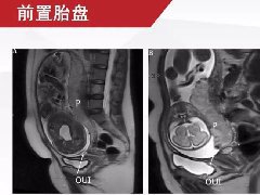 胎盘植入的MRI征象