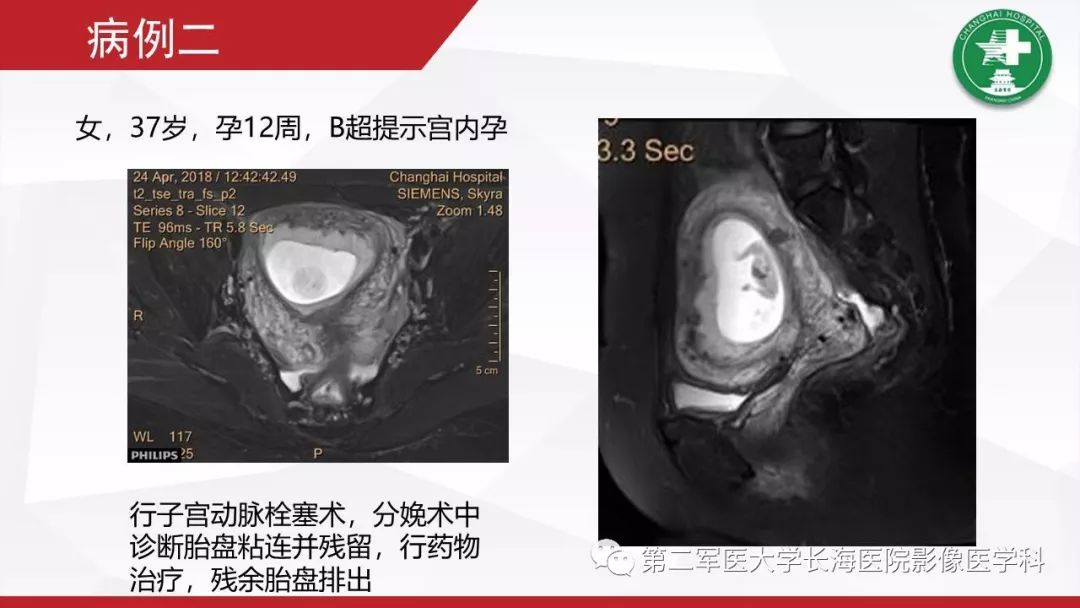 【PPT】胎盘植入的MRI征象