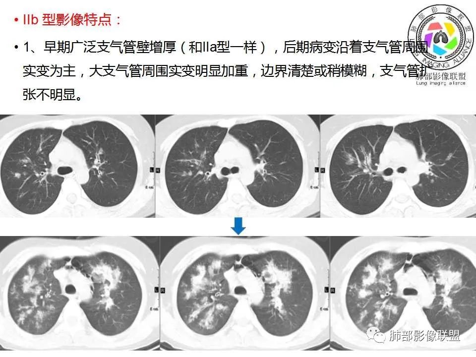 【PPT】侵袭性肺曲霉病影像分型及表现