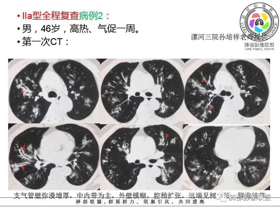 【PPT】侵袭性肺曲霉病影像分型及表现
