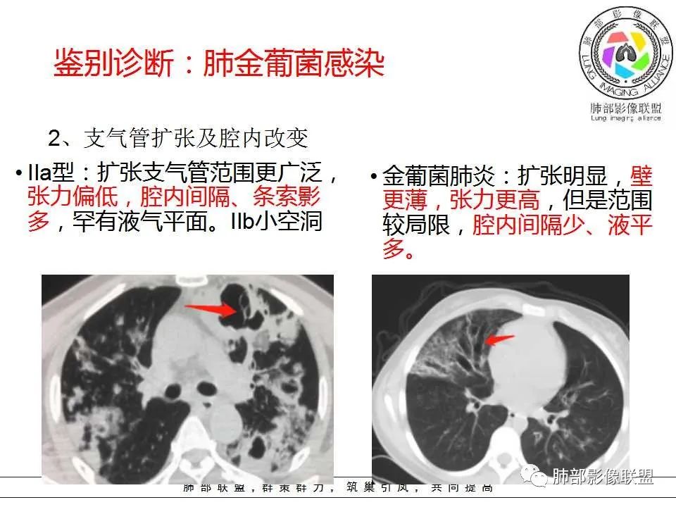 【PPT】侵袭性肺曲霉病影像分型及表现