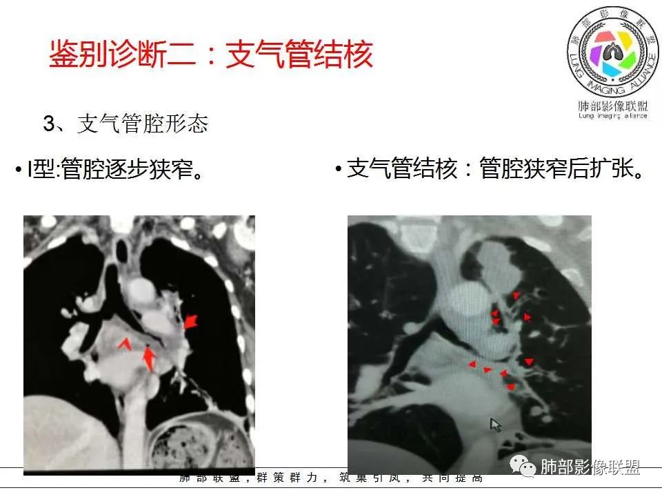 【PPT】侵袭性肺曲霉病影像分型及表现