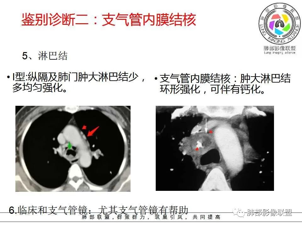 【PPT】侵袭性肺曲霉病影像分型及表现