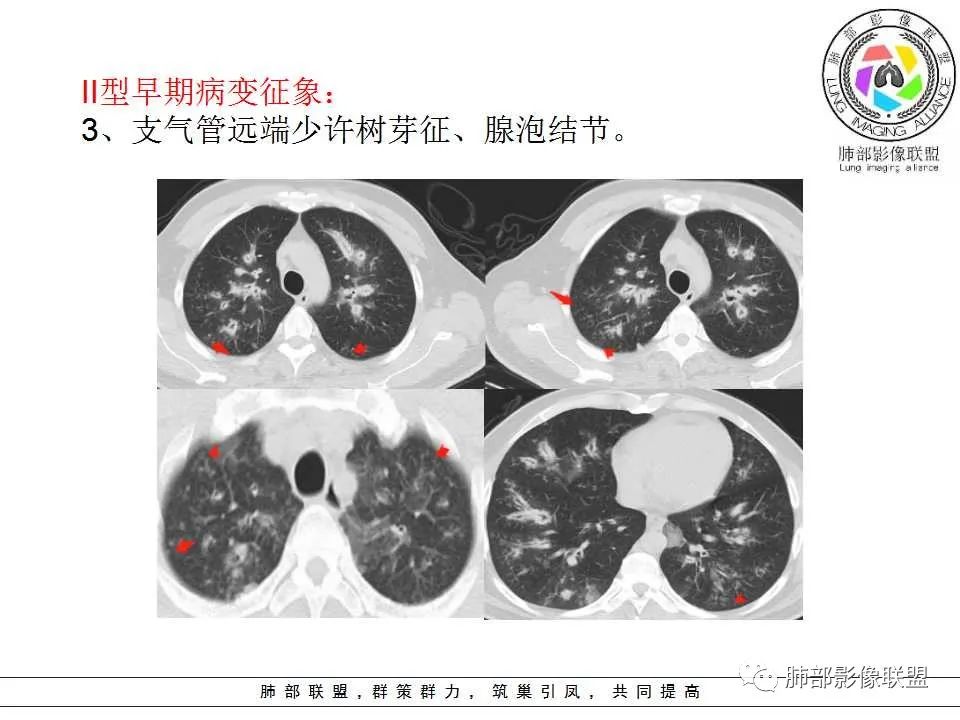 【PPT】侵袭性肺曲霉病影像分型及表现