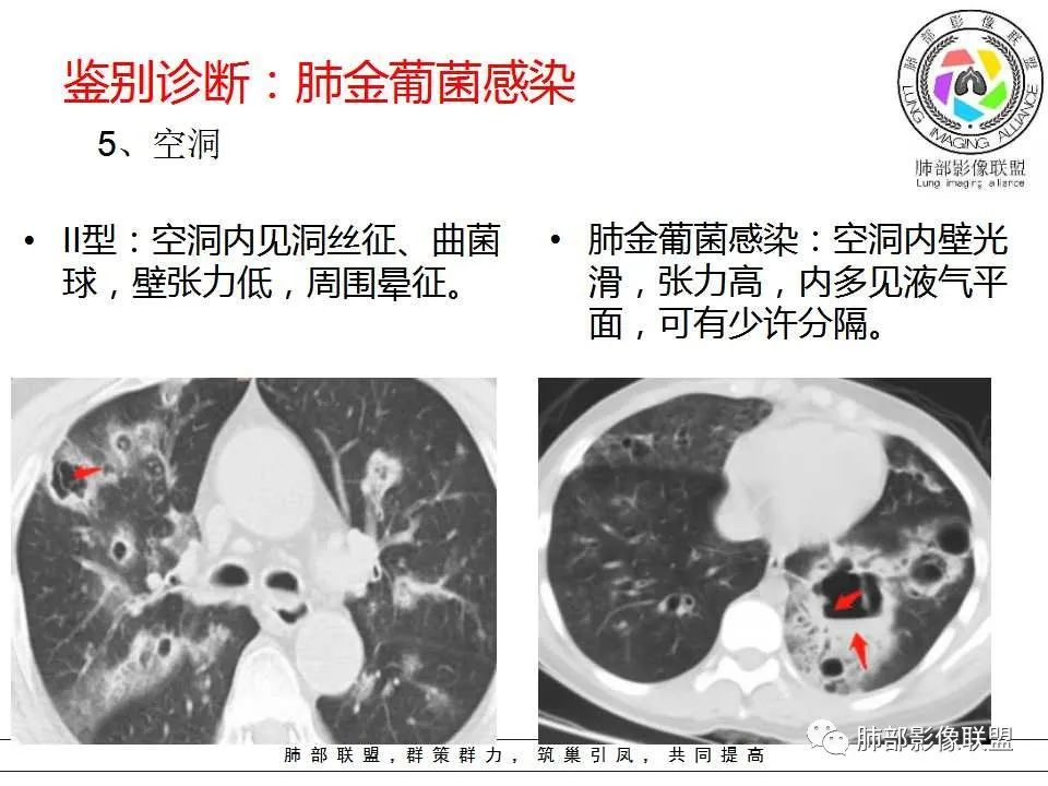 【PPT】侵袭性肺曲霉病影像分型及表现