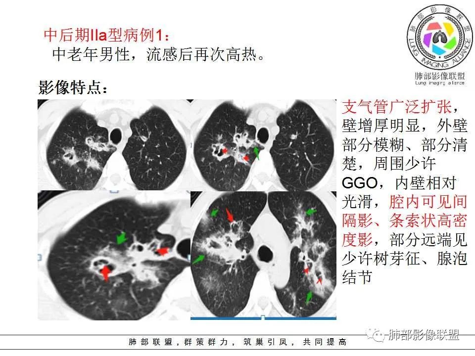 【PPT】侵袭性肺曲霉病影像分型及表现