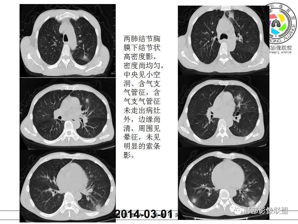 【PPT】侵袭性肺曲霉病影像分型及表现