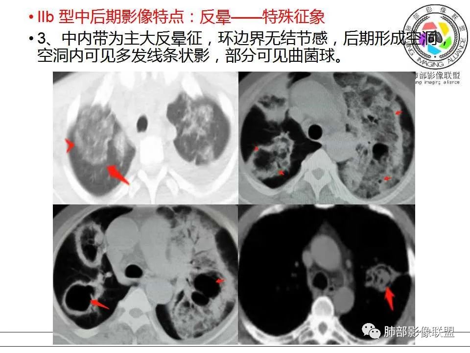【PPT】侵袭性肺曲霉病影像分型及表现
