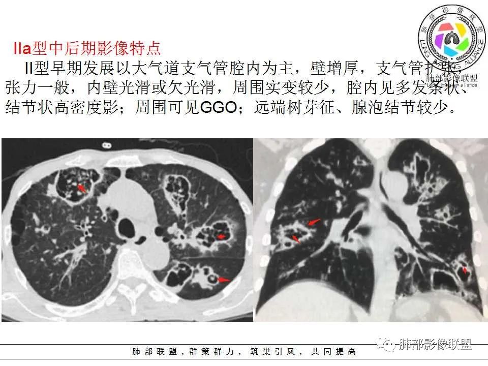 【PPT】侵袭性肺曲霉病影像分型及表现