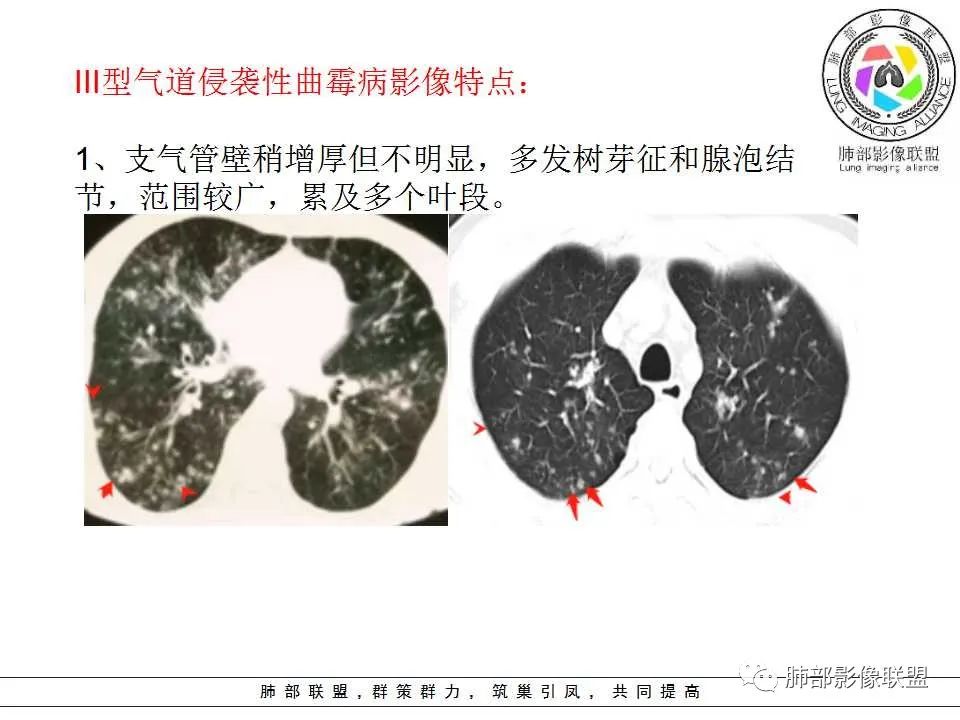 【PPT】侵袭性肺曲霉病影像分型及表现