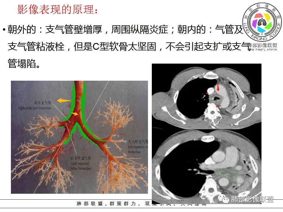 【PPT】侵袭性肺曲霉病影像分型及表现