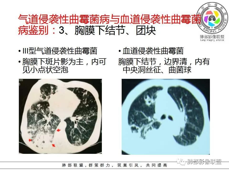 【PPT】侵袭性肺曲霉病影像分型及表现