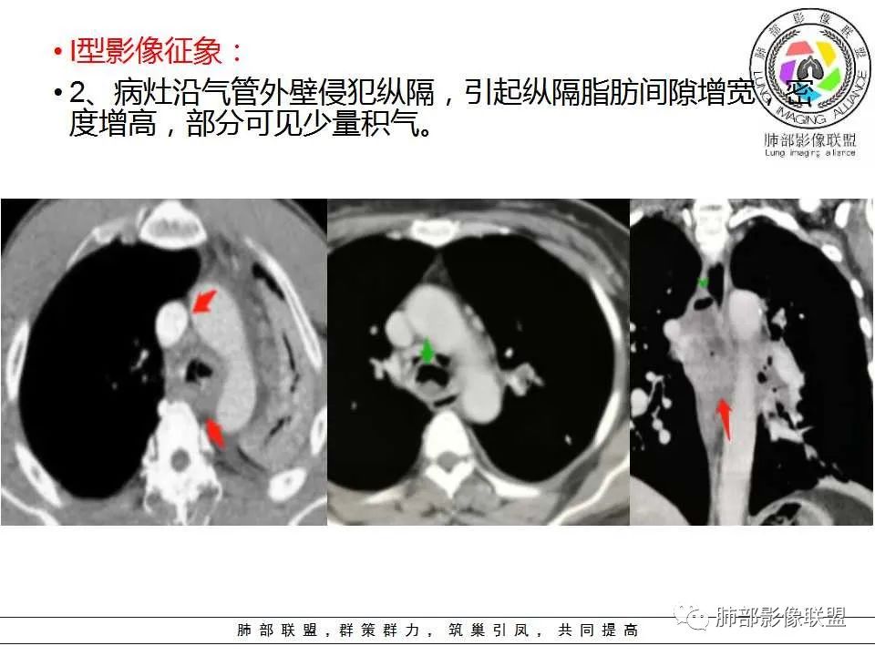 【PPT】侵袭性肺曲霉病影像分型及表现