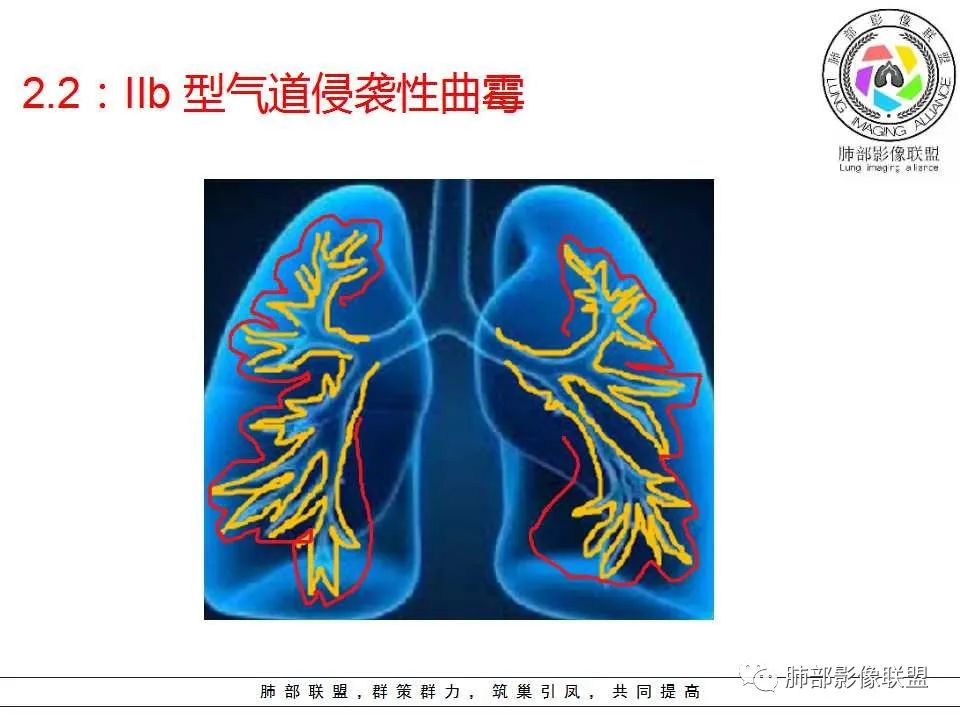 【PPT】侵袭性肺曲霉病影像分型及表现