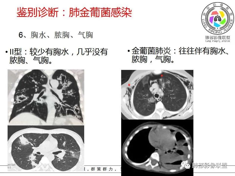【PPT】侵袭性肺曲霉病影像分型及表现
