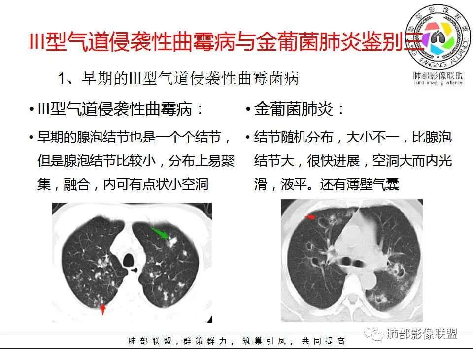 【PPT】侵袭性肺曲霉病影像分型及表现