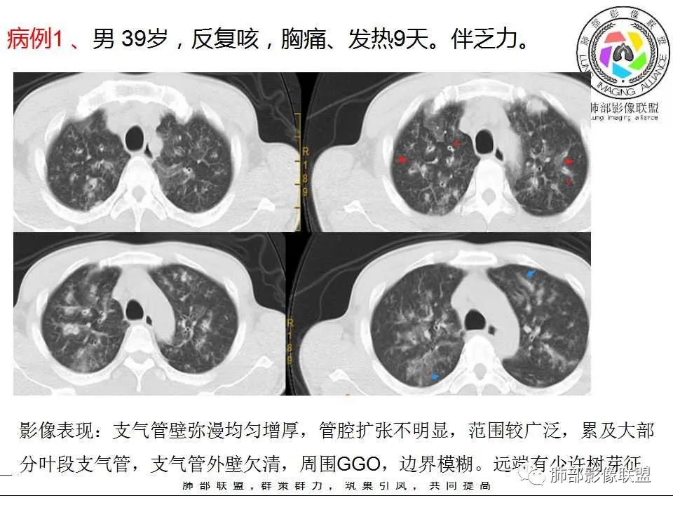 【PPT】侵袭性肺曲霉病影像分型及表现