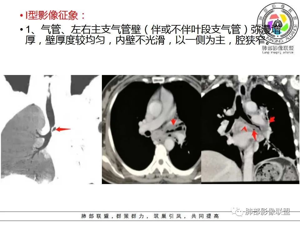 【PPT】侵袭性肺曲霉病影像分型及表现