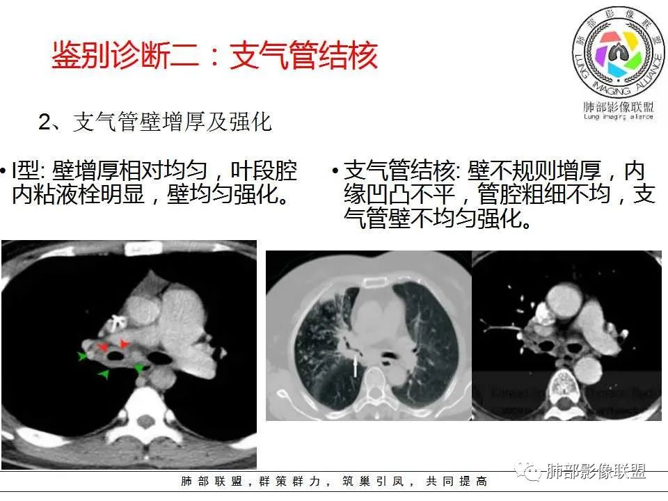 【PPT】侵袭性肺曲霉病影像分型及表现