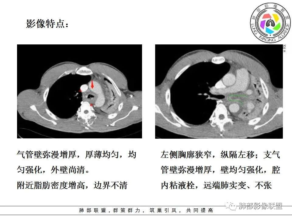 【PPT】侵袭性肺曲霉病影像分型及表现