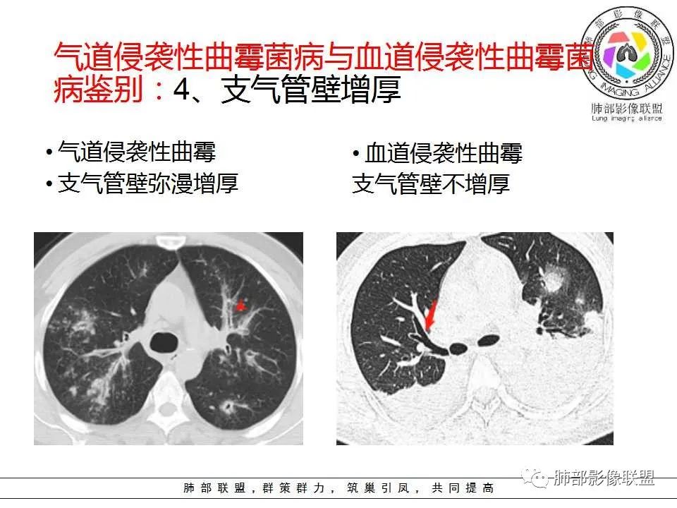 【PPT】侵袭性肺曲霉病影像分型及表现