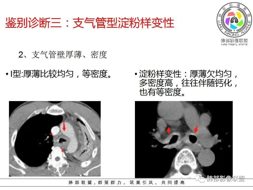 【PPT】侵袭性肺曲霉病影像分型及表现