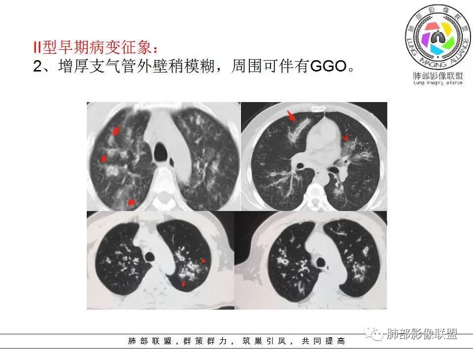 【PPT】侵袭性肺曲霉病影像分型及表现