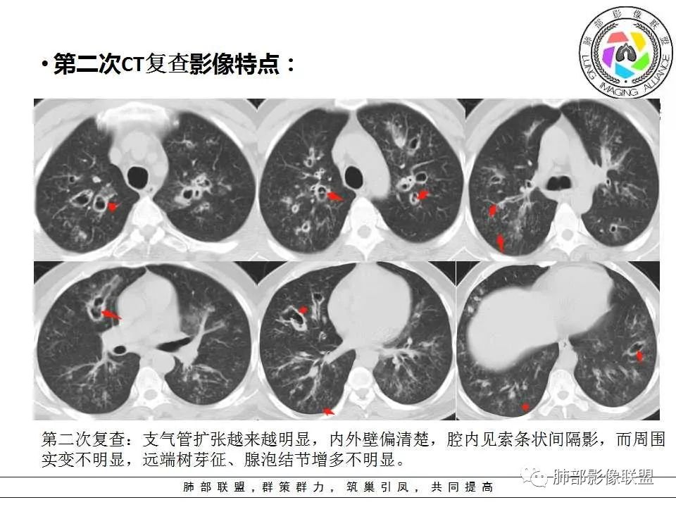 【PPT】侵袭性肺曲霉病影像分型及表现