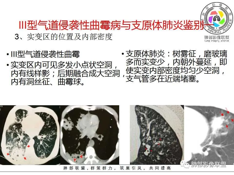 【PPT】侵袭性肺曲霉病影像分型及表现
