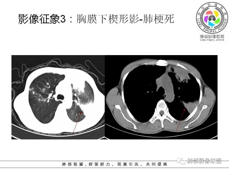 【PPT】侵袭性肺曲霉病影像分型及表现