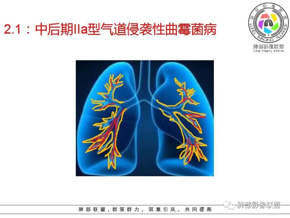 【PPT】侵袭性肺曲霉病影像分型及表现
