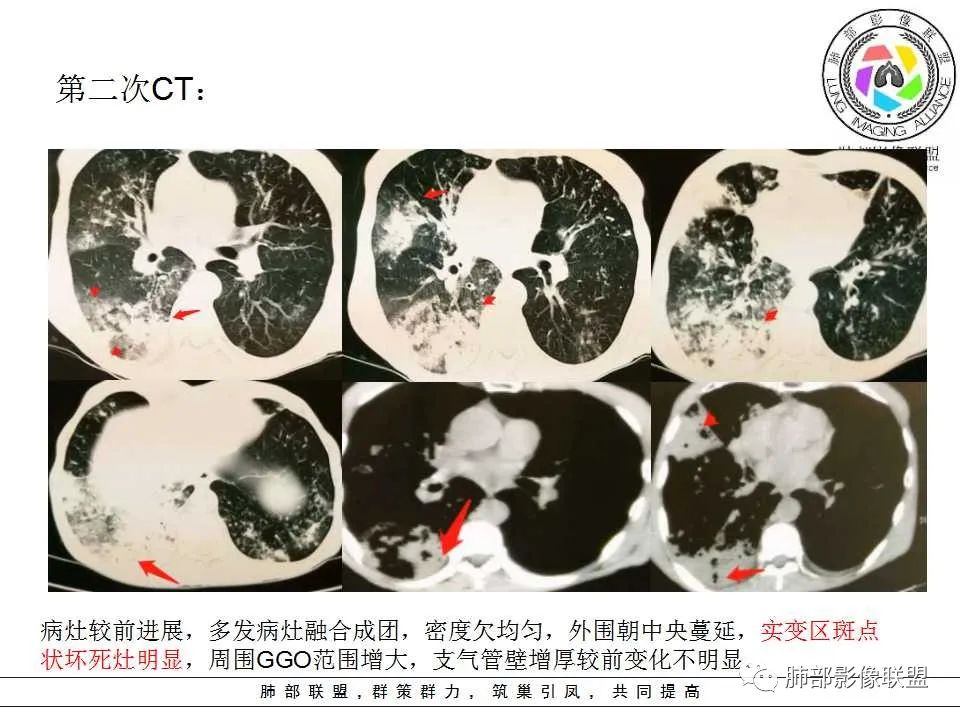 【PPT】侵袭性肺曲霉病影像分型及表现