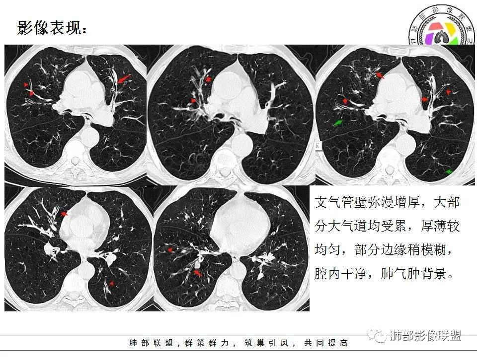 【PPT】侵袭性肺曲霉病影像分型及表现