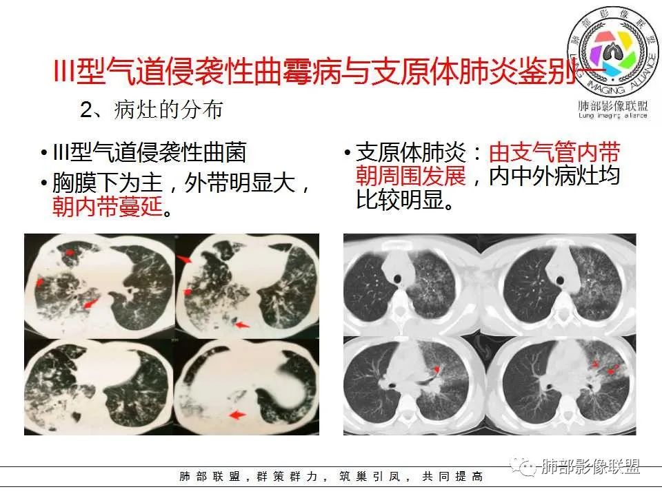 【PPT】侵袭性肺曲霉病影像分型及表现