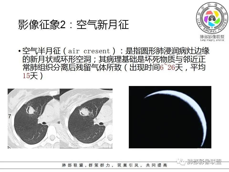 【PPT】侵袭性肺曲霉病影像分型及表现