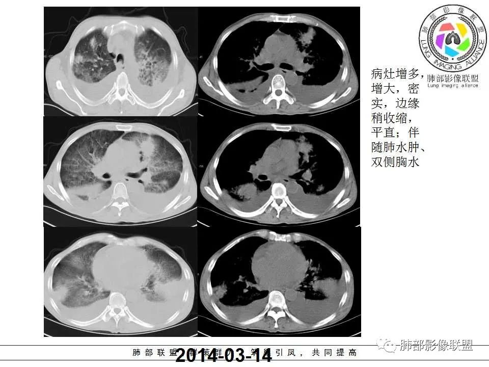 【PPT】侵袭性肺曲霉病影像分型及表现