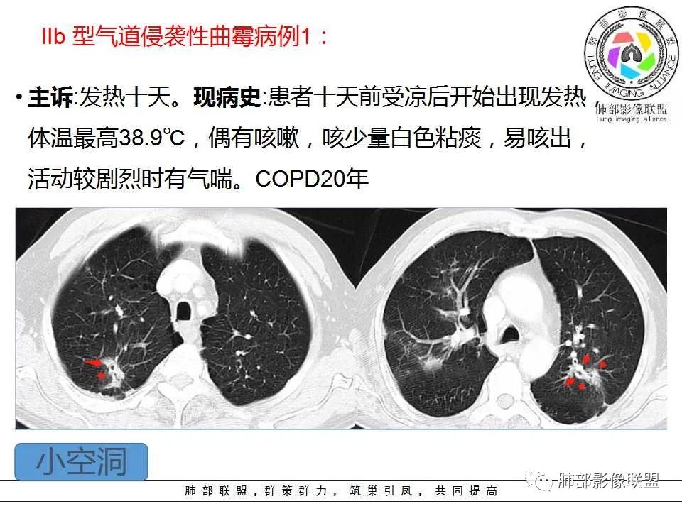 【PPT】侵袭性肺曲霉病影像分型及表现
