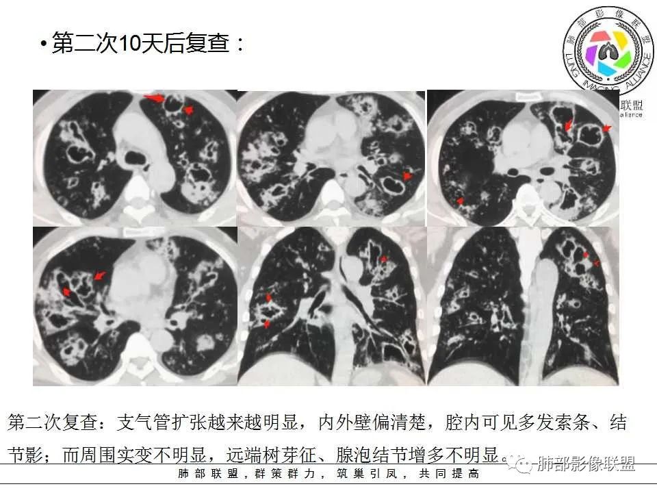 【PPT】侵袭性肺曲霉病影像分型及表现