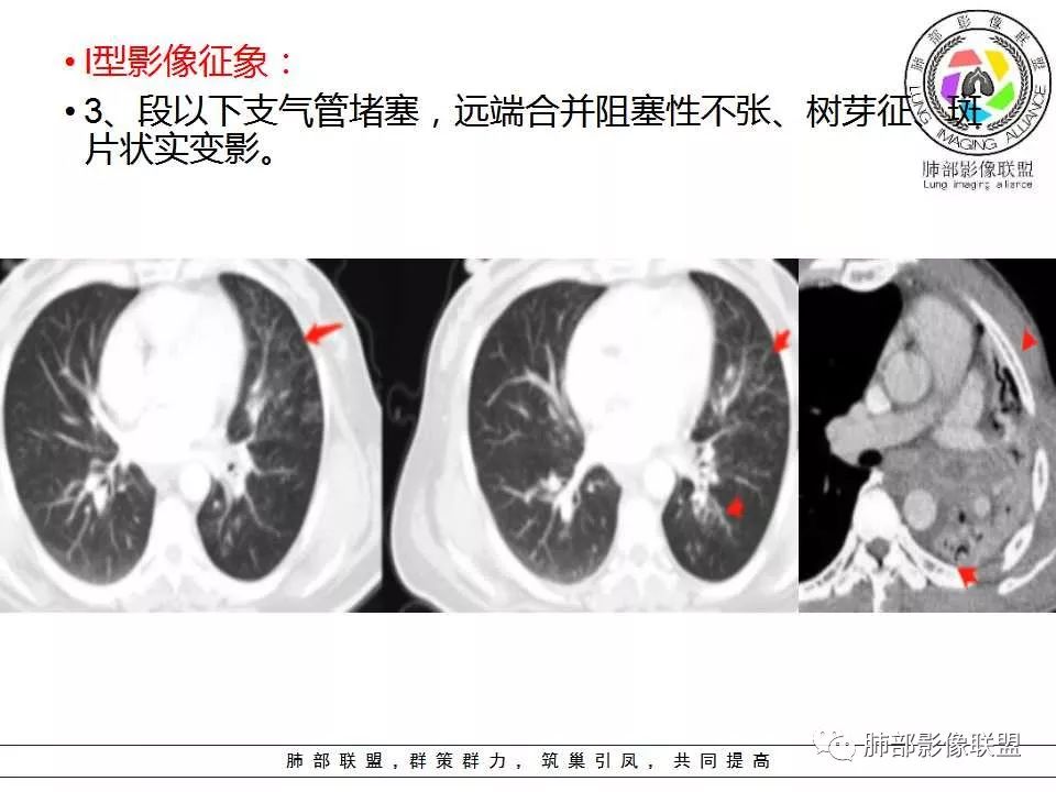 【PPT】侵袭性肺曲霉病影像分型及表现