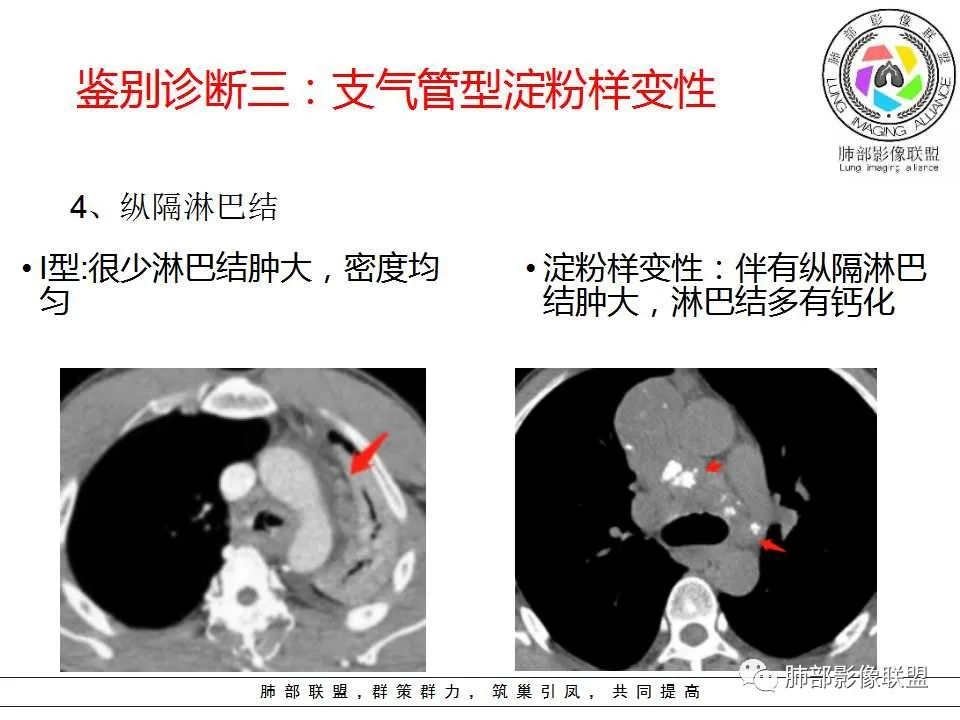 【PPT】侵袭性肺曲霉病影像分型及表现